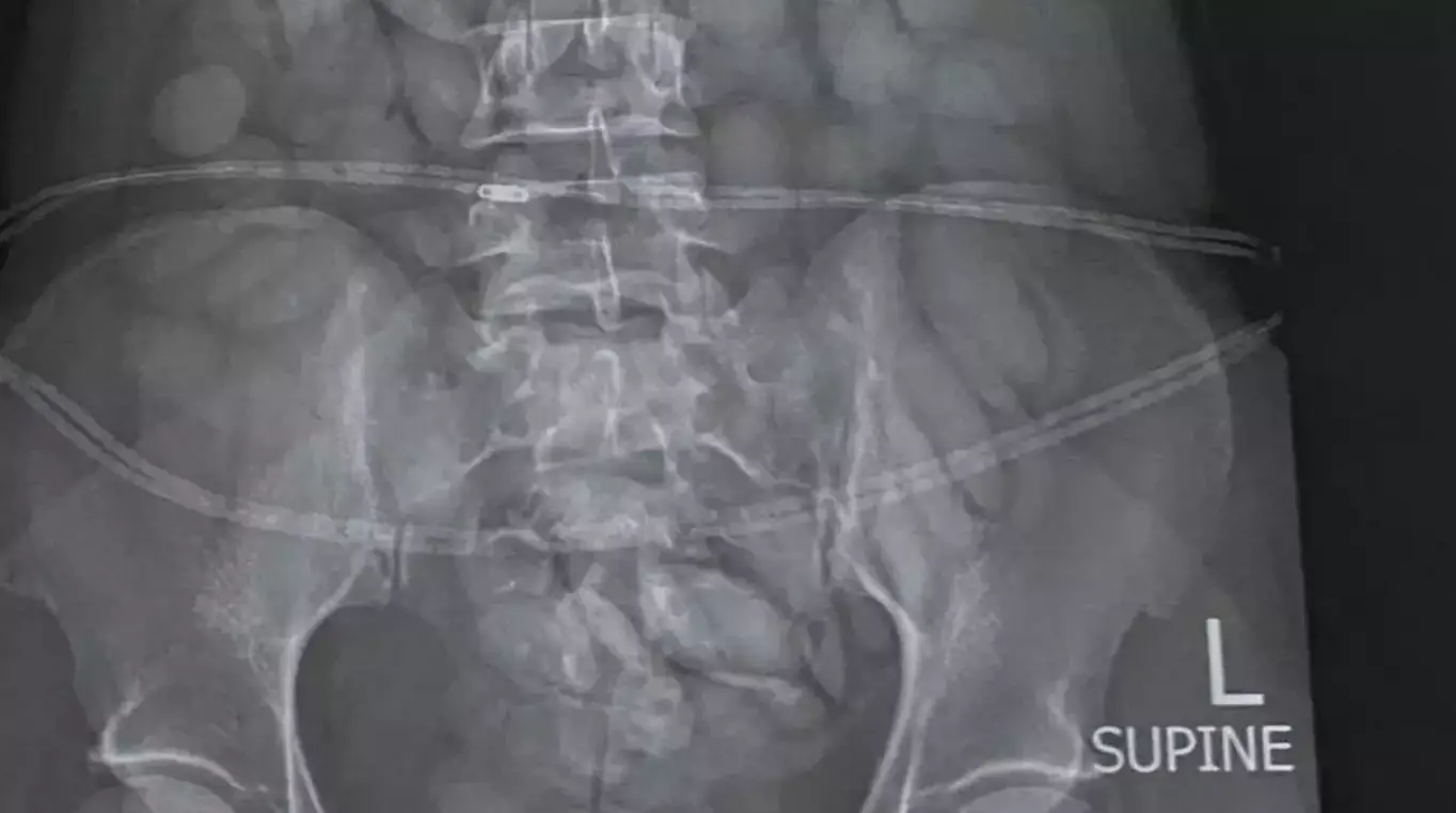 An X-ray showed more than 60 pellets of what is thought to be cocaine inside a woman's body (SA Police Services)