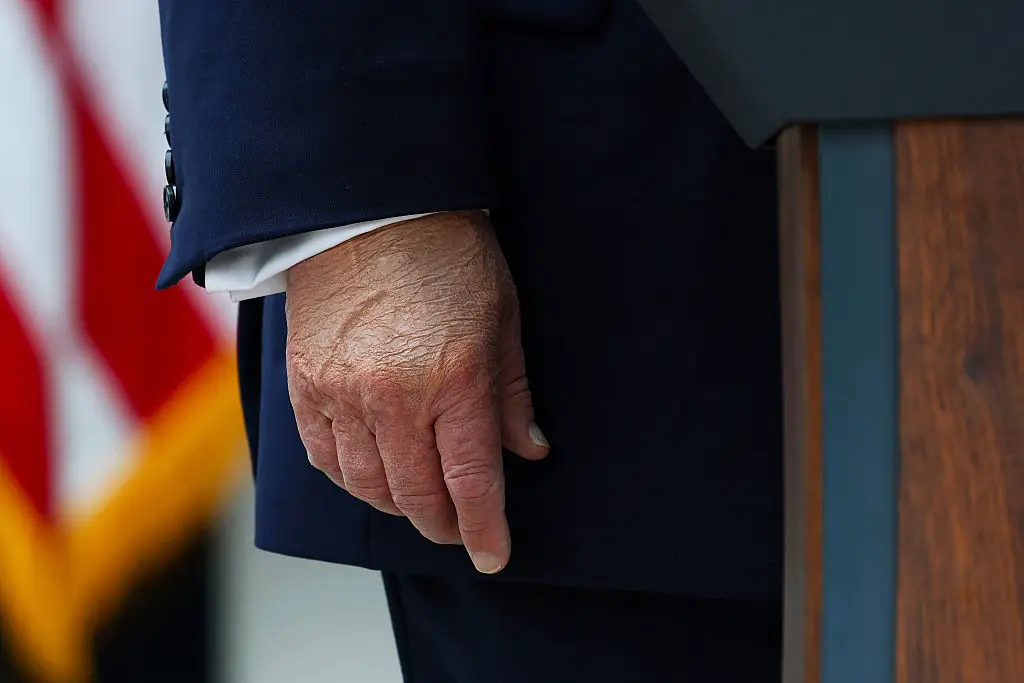 'Frequent handshaking' seemingly caused the bruising present on Trump's hand (Kevin Dietsch/Getty Images)
