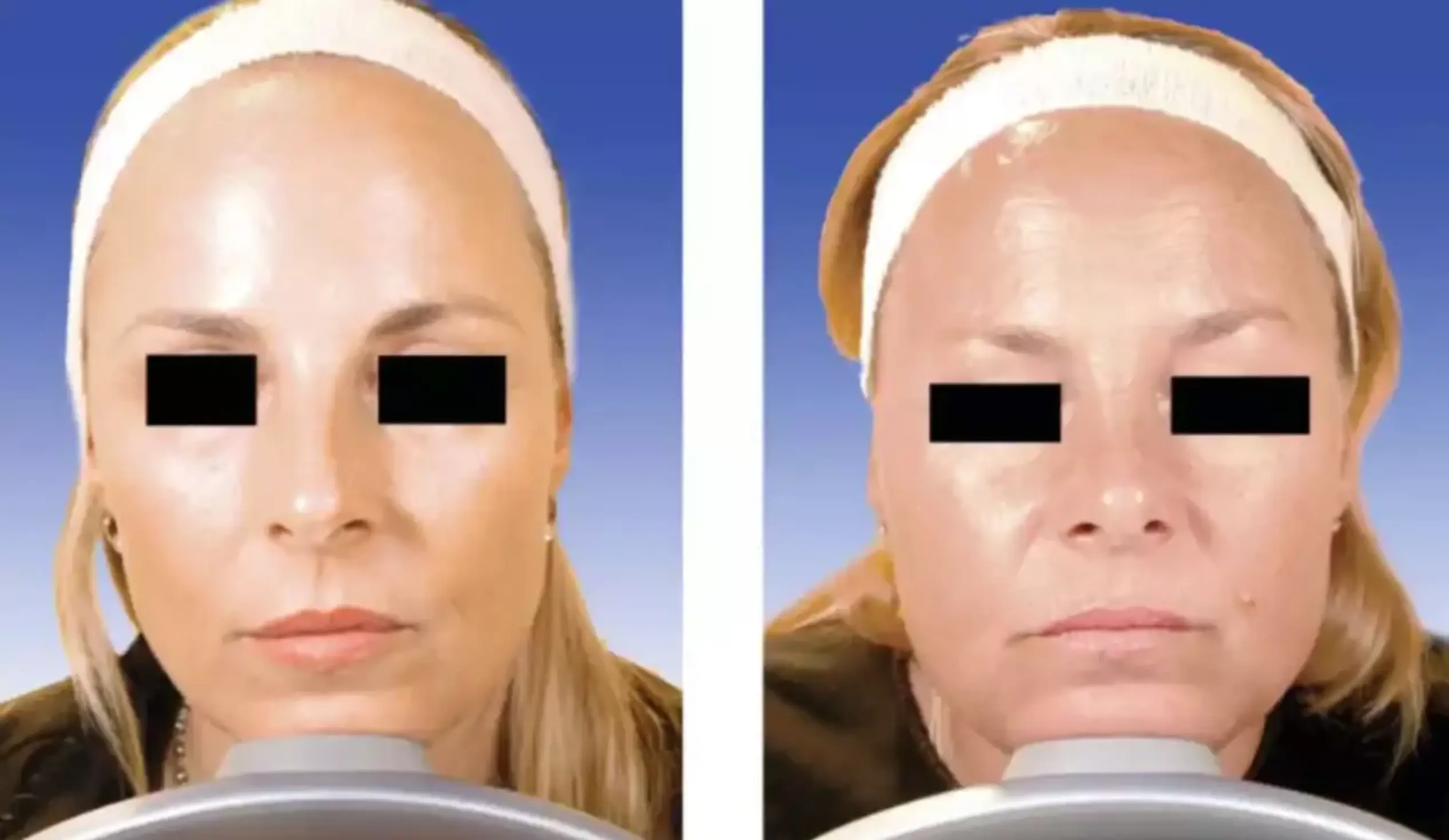Twin 1 (right) appeared to have a fuller face and jaw after 19 years with minimal Botox (American Society for Dermatologic Surgery)