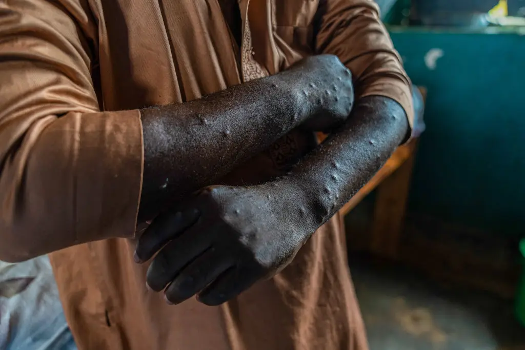 Lesions and blisters across the body are a key symptom of mpox (Glody Murhabazi/AFP via Getty Images)