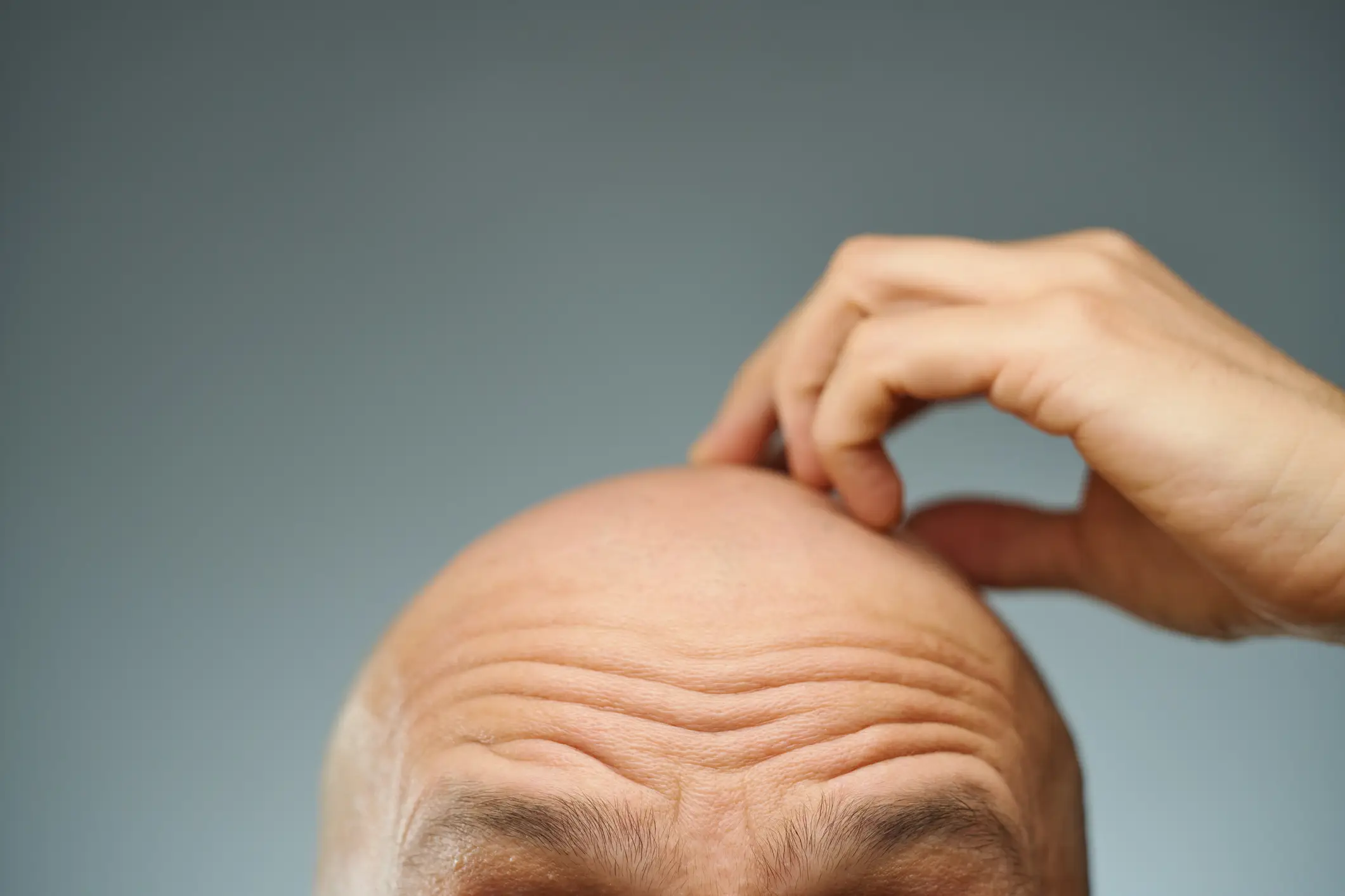 GLP-1 drugs have been linked to non-scarring alopecia, providing the potential for hair to grow back in the future (Delihayat/Getty Images)