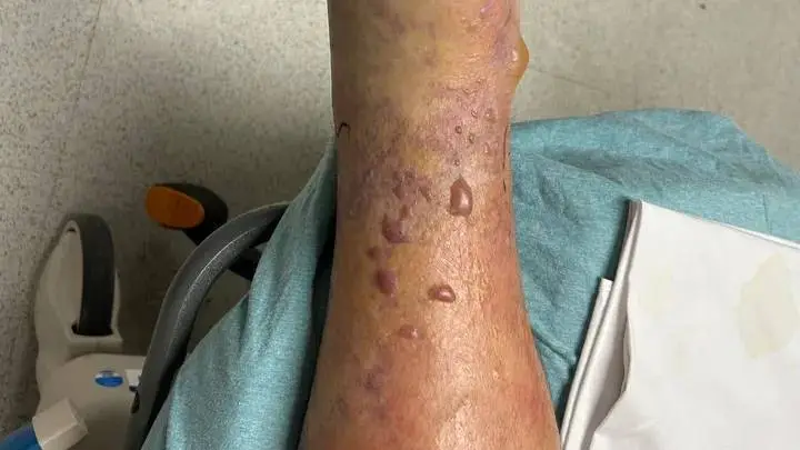 West is undergoing multiple surgeries due to contracting Vibrio Vulnificus (GoFundMe)