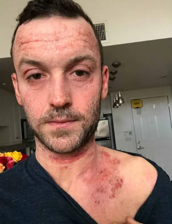 Jonathan's body was covered in the eczema.