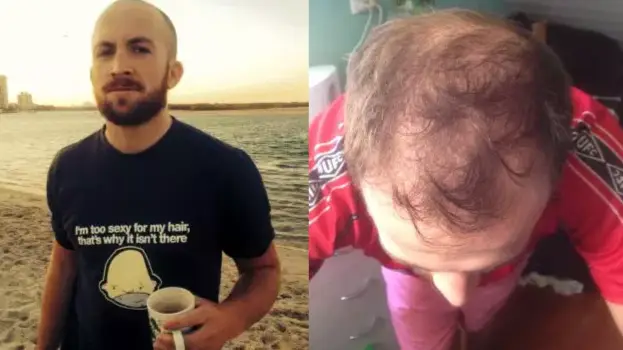 It's Better To Be Bald Than Balding